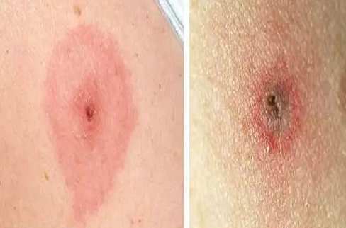 蜱蟲預防方法 蜱蟲預防方法