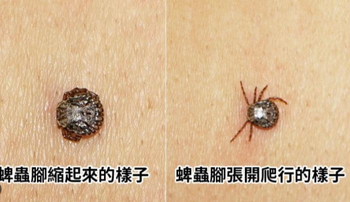牛蜱叮咬處理 牛蜱叮咬處理