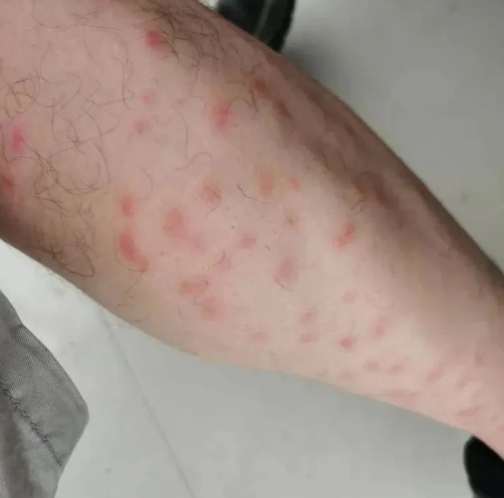 壁蝨叮咬預防 壁蝨叮咬預防