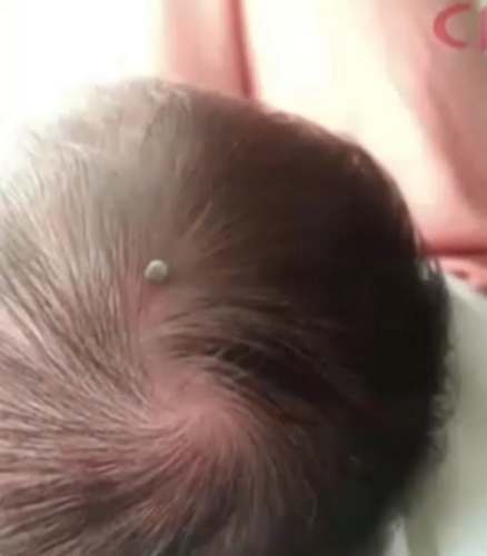牛蜱叮咬處理 牛蜱叮咬處理