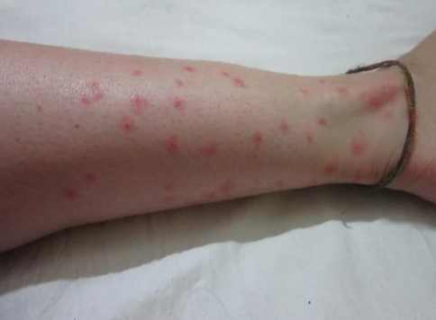壁蝨叮咬處理 壁蝨叮咬處理