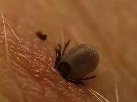 蜱蟲叮咬症狀 蜱蟲叮咬症狀