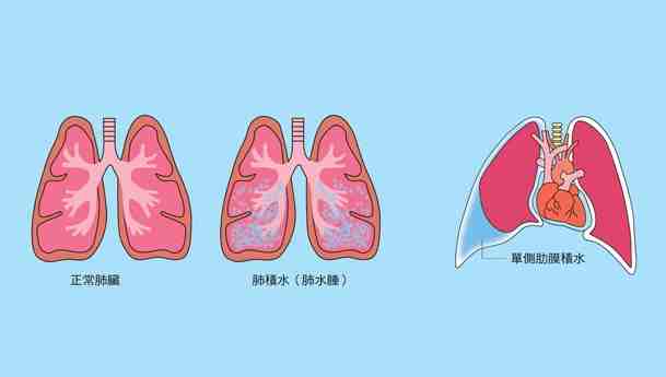 狗狗肺水腫