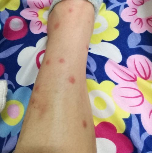 壁蝨叮咬預防 壁蝨叮咬預防