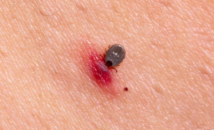萊姆病治療 萊姆病治療