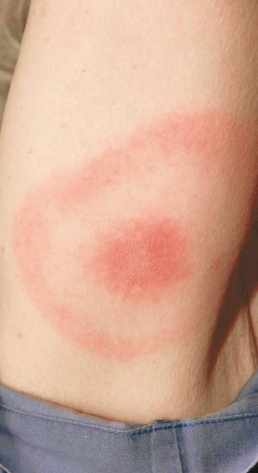 萊姆病治療 萊姆病治療