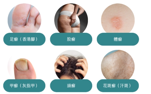 金錢癬治療方法 金錢癬治療方法