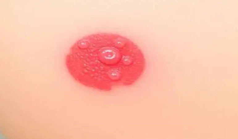 金錢癬症狀 金錢癬症狀