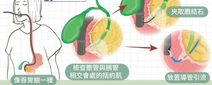 急性胰臟炎治療 急性胰臟炎治療