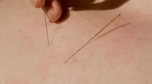 針灸治療脂肪瘤