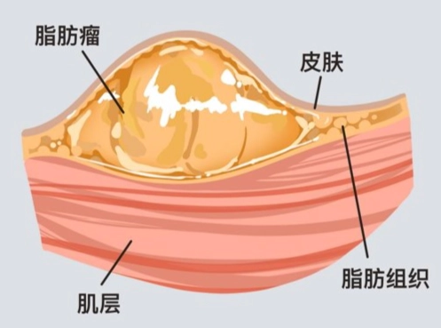 脂肪瘤 會自己好嗎 脂肪瘤 會自己好嗎