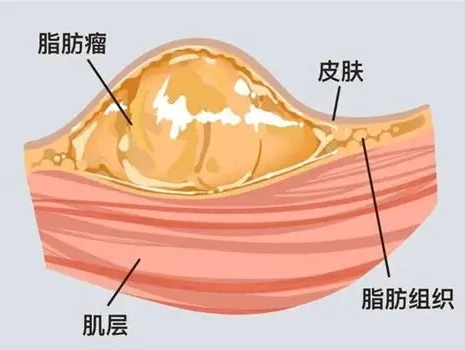 脂肪瘤消除 脂肪瘤消除