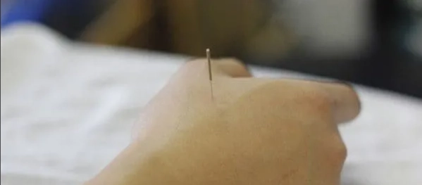 脂肪瘤針灸